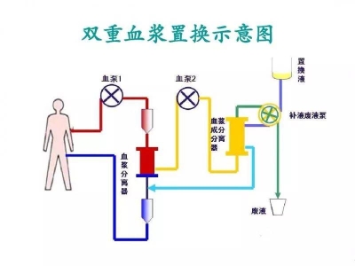 精准净化，焕活健康：DFPP双重血浆净化技术