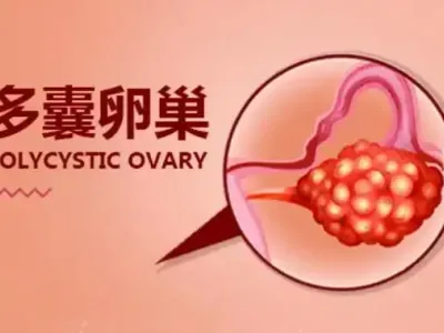 多囊调理,为何更需要个性化方案?