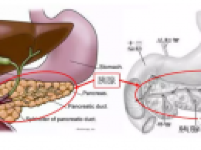 间充质干细胞是重症胰腺炎患者的新选择